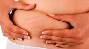 Como Combater Estrias